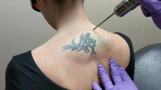 Laser Tattoo Removal  DermMedica