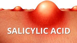 Heres WHY Salicylic Acid is Best For ACNE