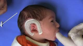 Cup Ear Infant Ear Deformity Corrected with EarWell® Infant Ear Deformity Correction Device