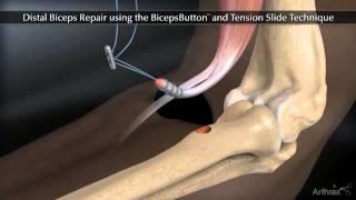 Arthrex Distal Biceps Button Tension Slide Technique