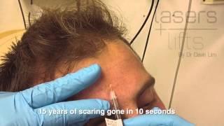 Chickpox scar treatment -10 second fix