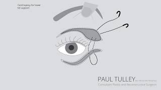 Eyelid Surgery  Eyelid Lift  Mr Paul Tulley