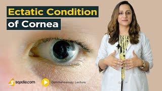 Ectatic Condition of Cornea  Ophthalmology Video Lecture  MD Education  V-Learning