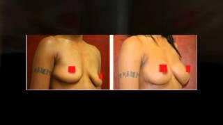 Breast Augmentation Washington DC & Lanham MD