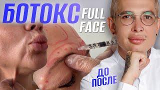 КАК КОЛОТЬ БОТОКС ПРАВИЛЬНО  FULL FACE  НЕ колите БОТОКС пока не посмотрите это видео #ботокс