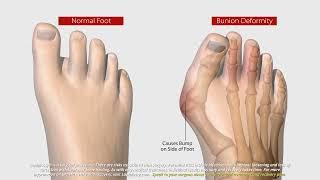 What Is Lapiplasty® 3D Bunion Correction®?  All About The Lapiplasty® Procedure