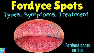 Fordyce Spots Symptoms Causes & Treatment  Fordyce Spots on lips  Fordyce Granules