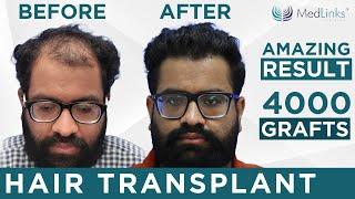 Best Hair Transplant In Delhi  Hair Transplant Cost in Delhi  Best Clinic and Best Doctor in Delhi