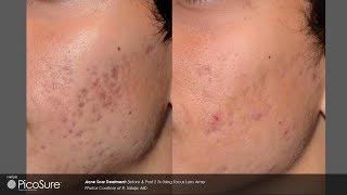 Laser Acne Scar Removal - Pulse light Clinic London