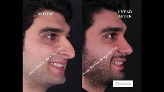 Male Rhinoplasty in Turkey