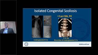 SRS Patient Webinar Scoliosis in the Young Child