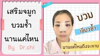 เสริมจมูกบวมช้ำนานแค่ไหน   How long does swelling last after rhinoplasty? By Phibeauty Clinic Phuket