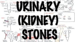 UrinaryKidney Stones - Overview signs and symptoms risk factors pathophysiology treatment