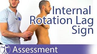 Internal Rotation Lag Sign  Subscapularis Tear