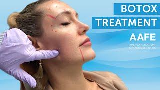 Botox Treatment  AAFE