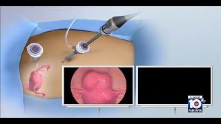 Minimally invasive approach treats fibroids