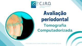 Tomografia computadorizada de feixe cônico para avaliação periodontal