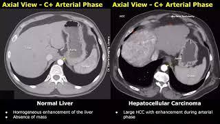 CT Scan Liver Normal Vs Hepatocellular Carcinoma HCC Images  Liver Cancer Imaging Diagnoses