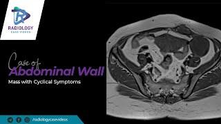 Case of Abdominal Wall Mass with Cyclical Symptoms - Scar endometriosis