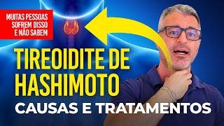 Tireoidite de Hashimoto Sintomas Causas e Tratamentos