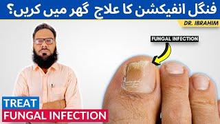 Fungus Ka Ilaj - Fungal Infection of Skin - Fungal Infection Treatment - Urdu Hindi - Dr. Ibrahim