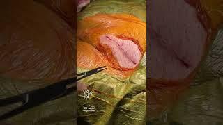 Closing an Inguinal Hernia Incision