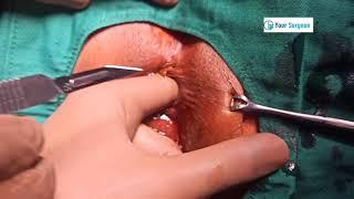 FISSURE SURGERY IN INDIA