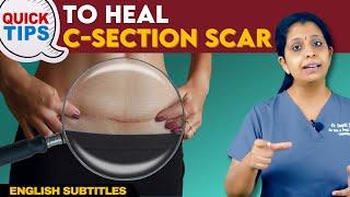 Quick Tips To Heal C-Section Scar  சிசேரியன் வடுக்களை எளிதில் எப்படி அகற்றுவது?