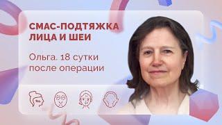 Ольга. СМАС. 18 сутки после операции