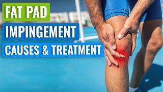 Hoffa’s Knee Fat Pad Impingement Syndrome - Causes & Treatment