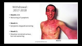 TSW Topical Steroid Withdrawal Case Example Santiago Aufranc