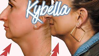 Kybella Experience Getting Rid of my Double Chin {Over 40}