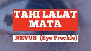 Tahi Lalat Mata Nevus Eye Freckle - Solehudin Widya Putra