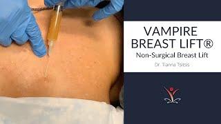 Vampire Breast Lift®