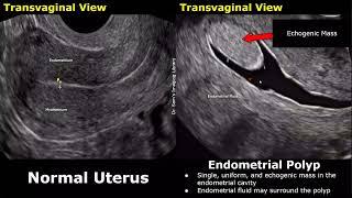 Uterus Ultrasound Normal Vs Endometrial Polyp Images  Feeding Artery Interrupted Mucosa Sign USG