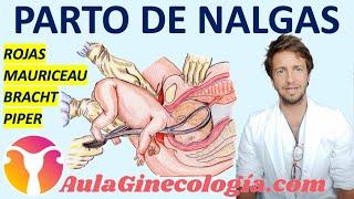 PARTO DE NALGAS    ROJAS MAURICEAU BRACHT FÓRCEPS DE PIPER... - Ginecología y Obstetricia -