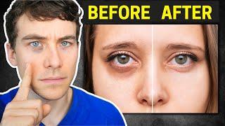 The Truth about Dark Circles Causes and Proven Treatments