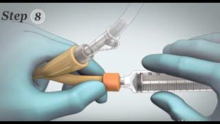 Removal of Foley Catheter Male