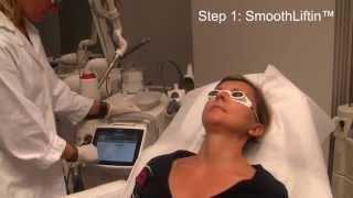 FOTONA 4D - Non invasive laser face-lifting