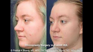 Rhinoplasty Everett WA  Nose Job Seattle Washington - Prabhat K. Bhama MD