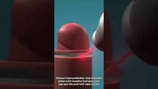 Animasi tutorial sunat laser  tutorial circumcision electrical cauter animation 