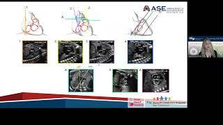 Guidelines and Recommendations for Performance of the Fetal Echocardiogram An Update from ASE