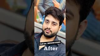 Before to After look ️  Permanent Hair Patch Delhi  Call Us  9650914665 #wigs #hairpatch