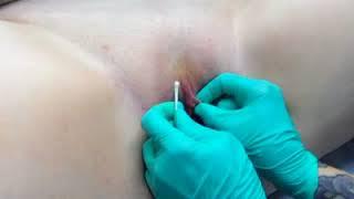 The q-tip test for VCH vertical hood piercing suitability