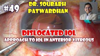 Commented 49 approach to Dislocated IOL in anterior Vitreous Dr Sourabh Patwardhan