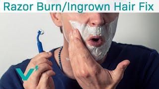 Preventing Razor Burn and Ingrown Hairs