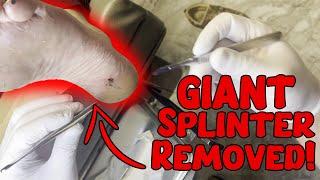 Splinter Removal Watch as We Extract a Massive Splinter from a Patients Heel