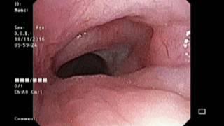 sec laryngotracheomalacia