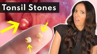 What Are Tonsil Stones & How To SAFELY Remove Them