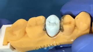 Tooth waxup  Tutorial 